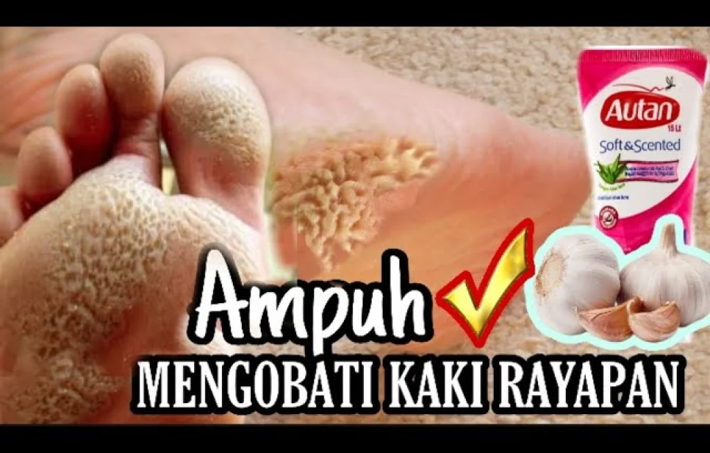 obat kaki rayapan ampuh